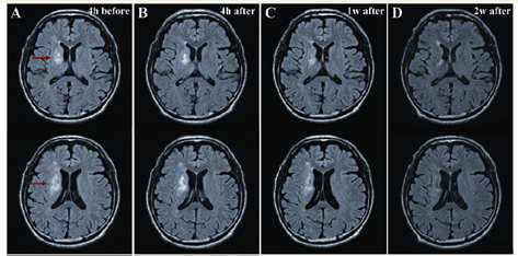 骨髄由来幹細胞での治療後にMRIにより脳の損傷部を観察した写真