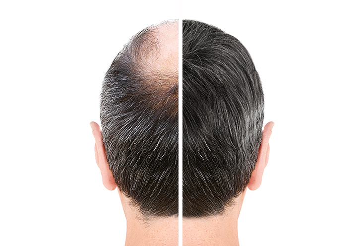 女性も男性も安心して受けられるPRP(多血小板血漿)毛髪再生療法